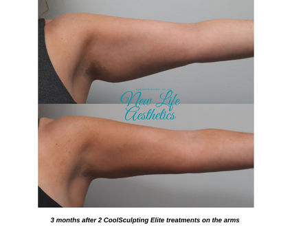 CoolSculpting Elite Treatment Raleigh NC