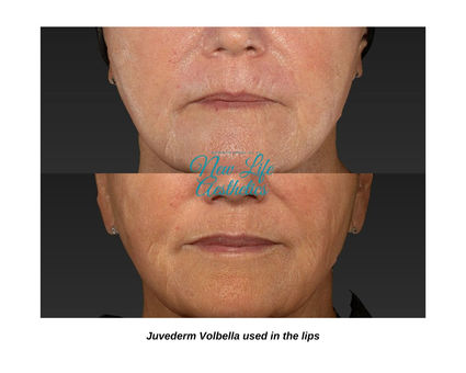 Juvederm Filler Treatment Raleigh NC