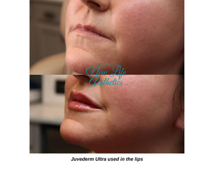 Juvederm Filler Treatment Raleigh NC