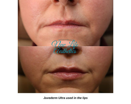 Juvederm Filler Treatment Raleigh NC