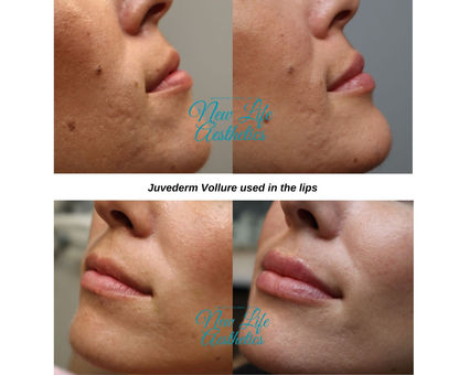 Juvederm Filler Treatment Raleigh NC