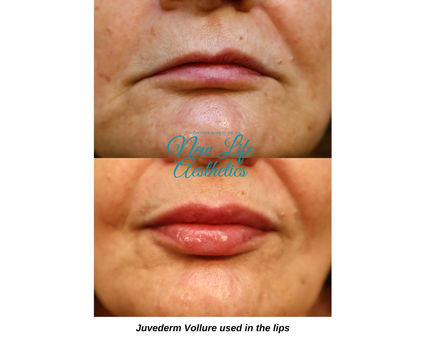 Juvederm Filler Treatment Raleigh NC