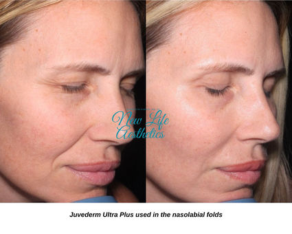 Juvederm Filler Treatment Raleigh NC