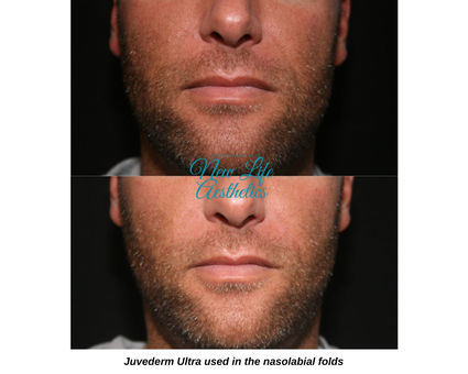 Juvederm Filler Treatment Raleigh NC