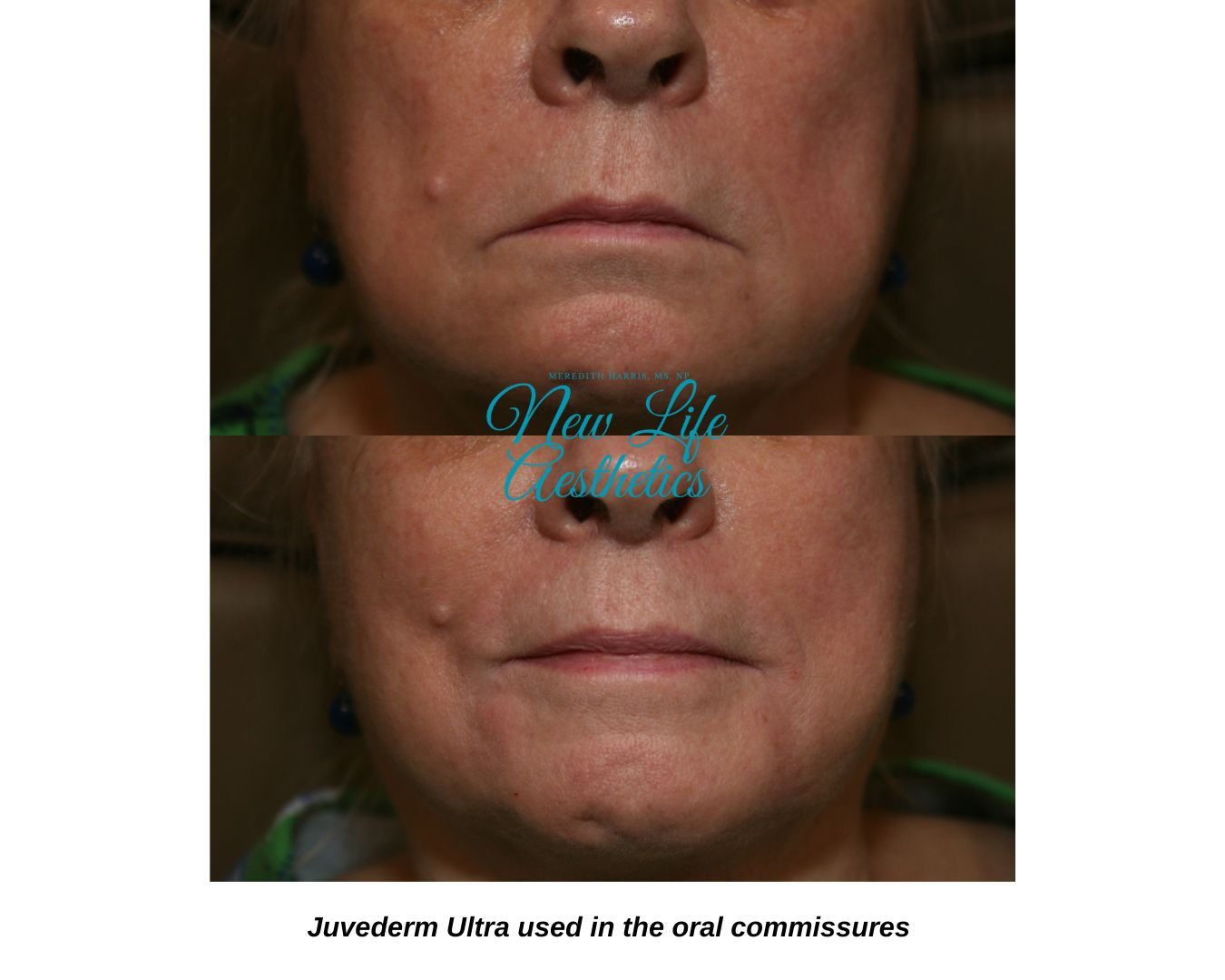 Dermal Fillers Raleigh | Juvederm Volbella, Vollure, Voluma, Volux