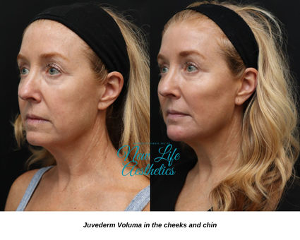 Juvederm Filler Treatment Raleigh NC