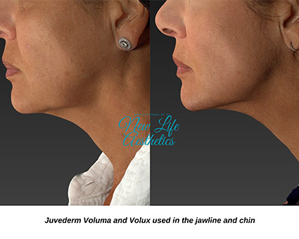 Juvederm Filler Treatment Raleigh NC