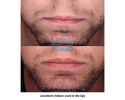 Juvederm Filler Treatment Raleigh NC