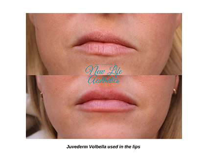 Juvederm Filler Treatment Raleigh NC