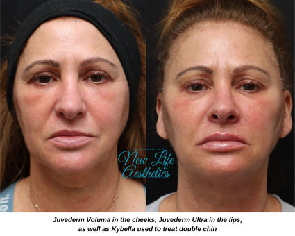 Juvederm Filler Treatment Raleigh NC