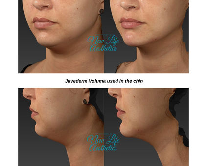 Juvederm Filler Treatment Raleigh NC