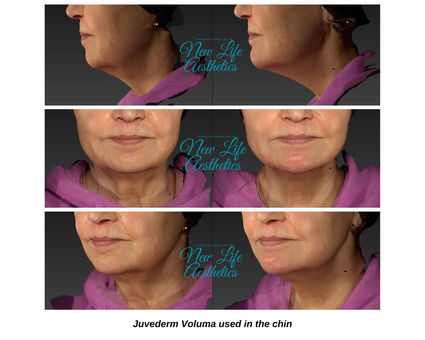 Juvederm Filler Treatment Raleigh NC