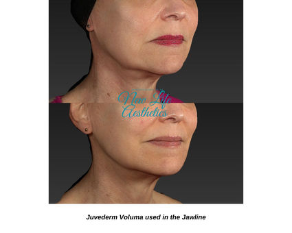 Juvederm Filler Treatment Raleigh NC