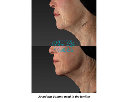 Juvederm Filler Treatment Raleigh NC