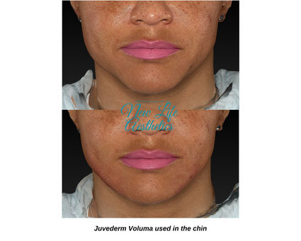 Juvederm Filler Treatment Raleigh NC