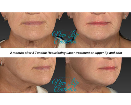 Tunable Resurfacing Laser Treatment Raleigh NC