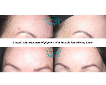 Tunable Resurfacing Laser Treatment Raleigh NC