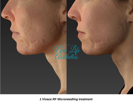 Vivace RF Microneedling Raleigh NC