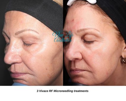 Vivace RF Microneedling Raleigh NC