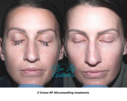 Vivace RF Microneedling Raleigh NC