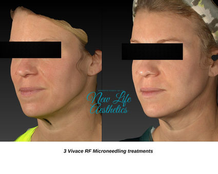 Vivace RF Microneedling Raleigh NC